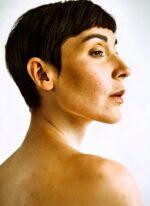 Melasma, hiperpigmentación que aparece en la cara