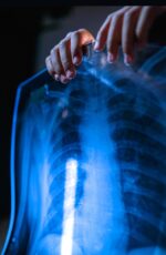 La Fibrosis pulmonar afecta principalmente a personas mayores de 50 años y en su mayoría a hombres