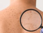 El melanoma silencioso que preocupa en México: Rafa Nadal impulsa campaña de prevención