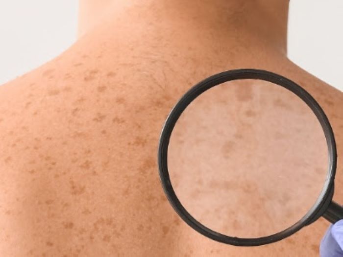 El melanoma silencioso que preocupa en México: Rafa Nadal impulsa campaña de prevención El melanoma silencioso que preocupa en México: Rafa Nadal impulsa campaña de prevención