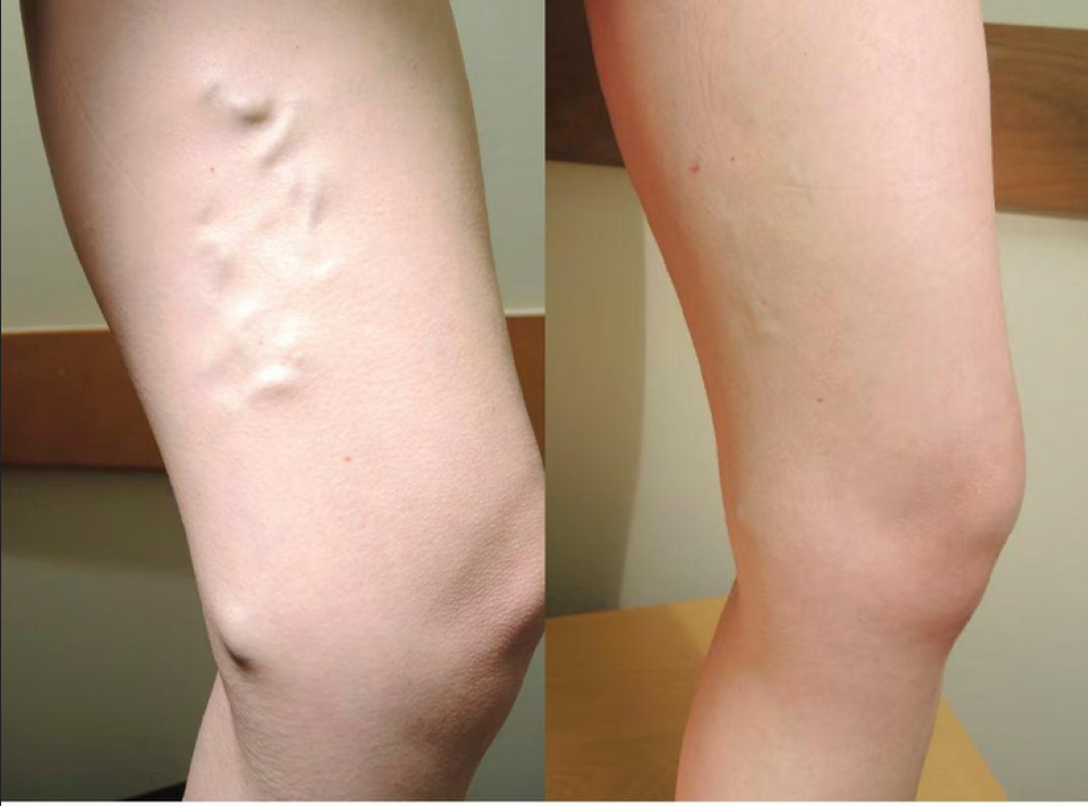 Venas varicosas: un problema de salud que va más allá de la estética Venas varicosas: un problema de salud que va más allá de la estética